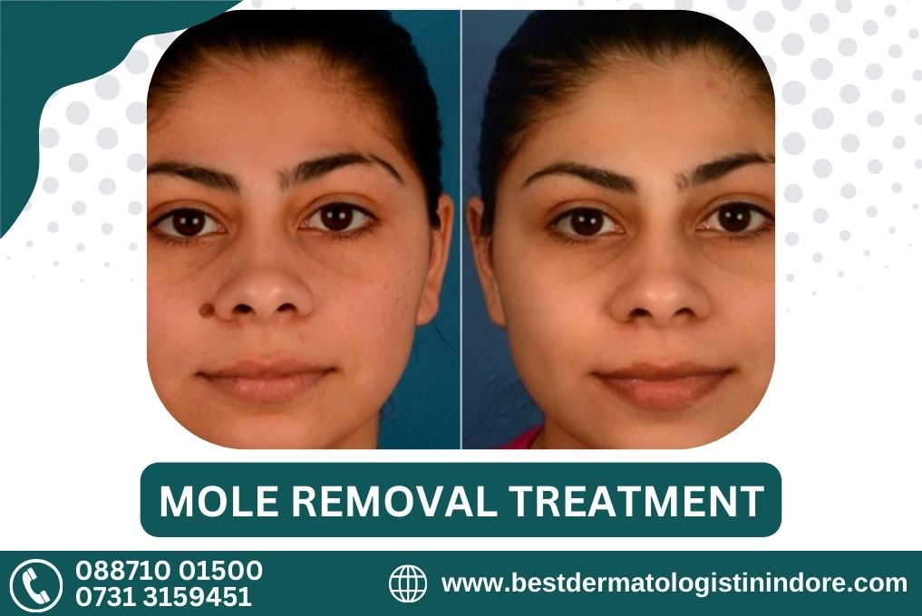 Best Doctor for Mole Removal Treatment in Dewas